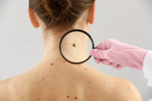 skin cancer exam